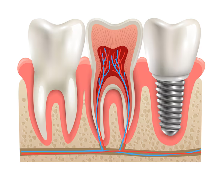 single tooth implant pittsburgh pa