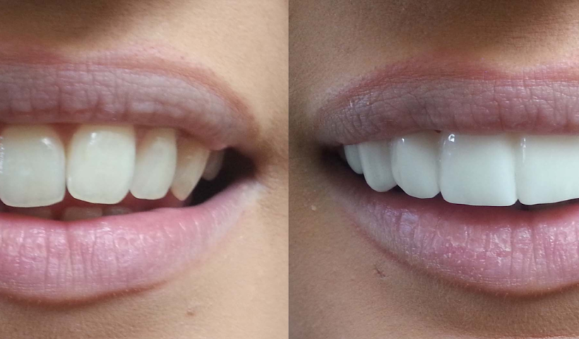 veneers before and after