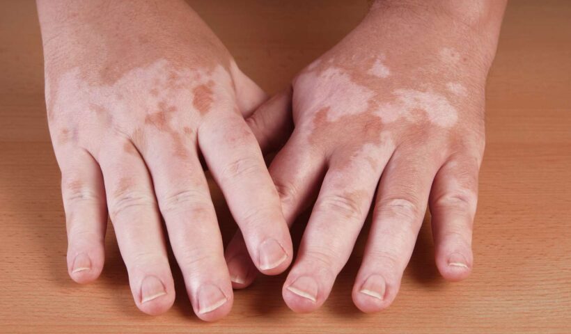 vitiligo-58d307df3df78c5162639661