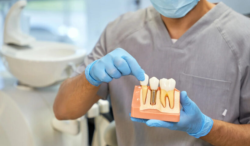 Dental Implants in West Houston: A Comprehensive Guide to Benefits, Types, Success Rates, and Maintenance