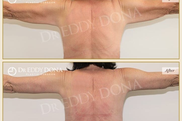 Dr-Eddy-Dona-Arm-Lift-O6847-B-min