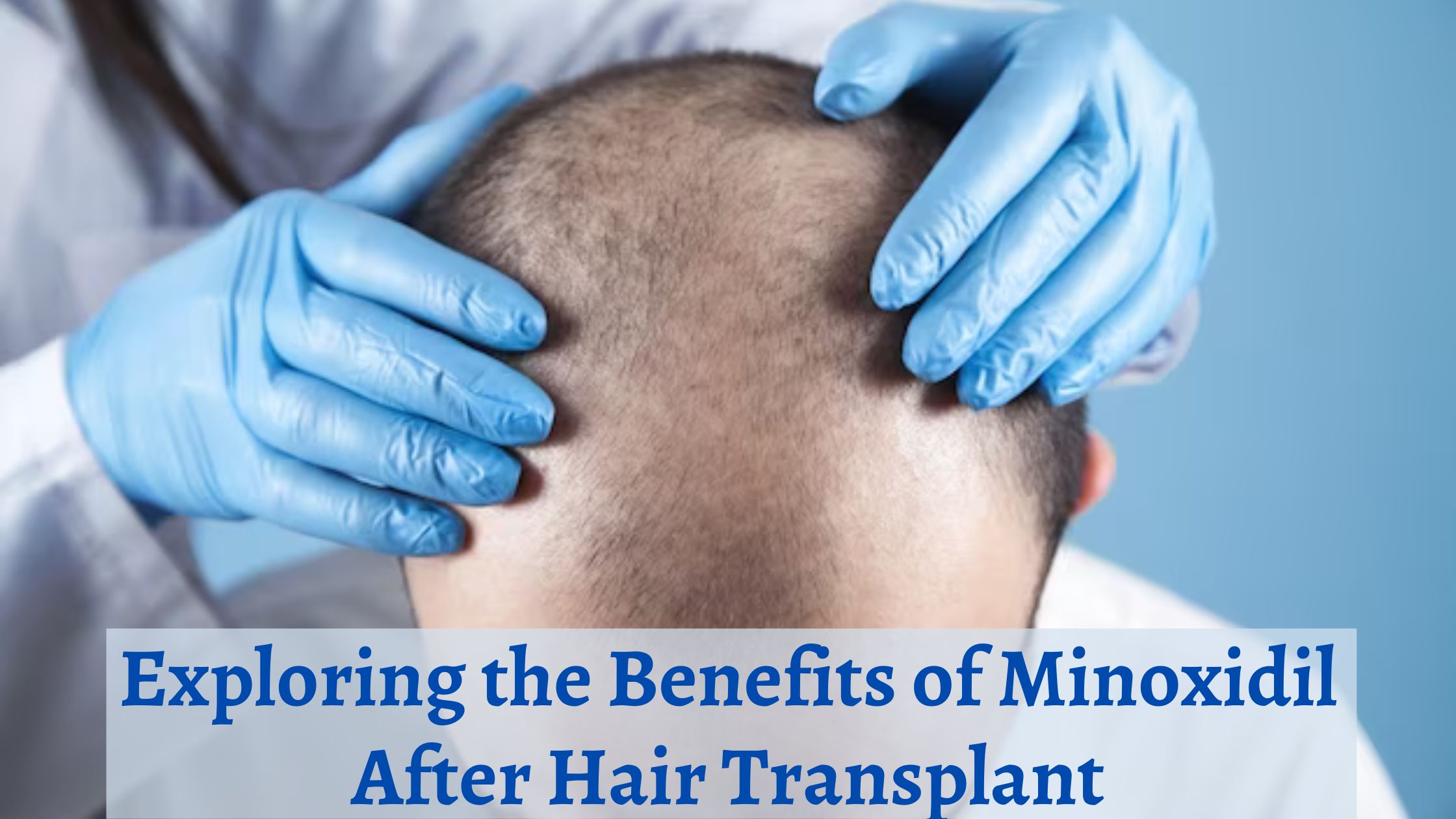 Exploring-the-Benefits-of-Minoxidil-After-Hair-Transplant