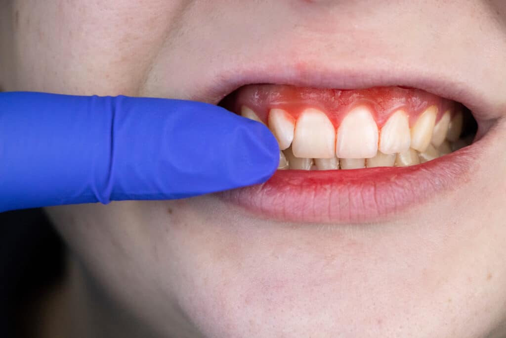 Gum Disease Treatment in Houston: Your Path to a Healthy Smile