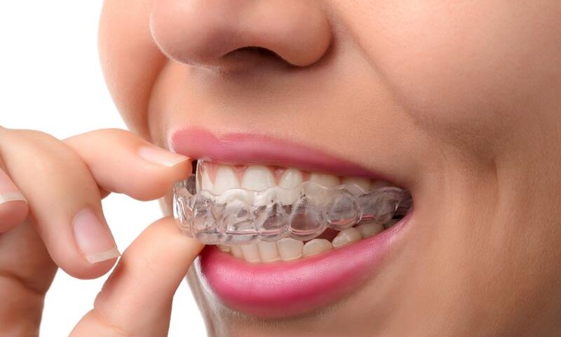 Pros and Cons of Invisalign Treatment in Tallahassee, FL