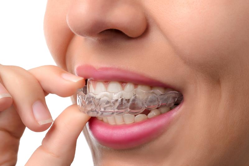 Pros and Cons of Invisalign Treatment in Tallahassee, FL