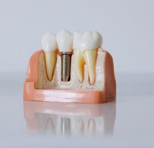 implant dentures in palmdale
