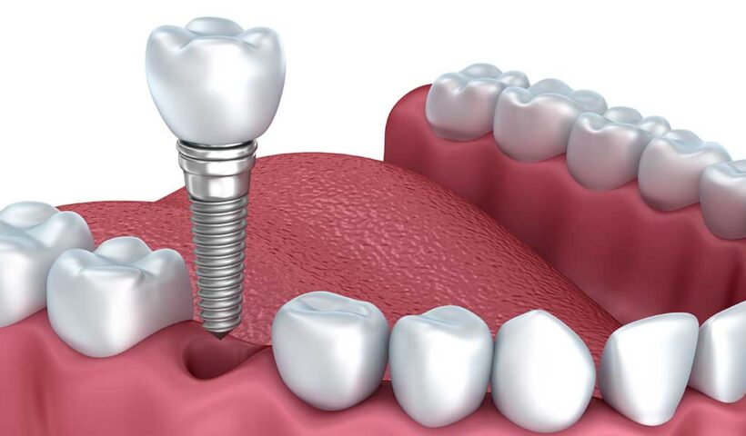 All-on-4 Dental Implants in West Houston