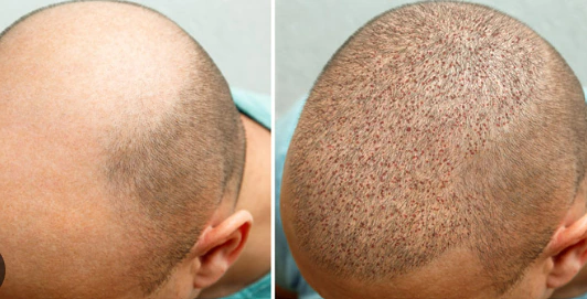 7 days after hair transplant