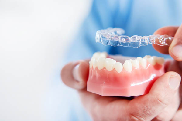 Exploring the benefits of dental Inlays