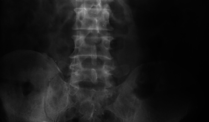 KUB-After-Placement-of-DJ-Stent-in-Right-Ureter