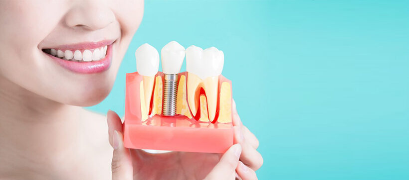 Markham dental implants