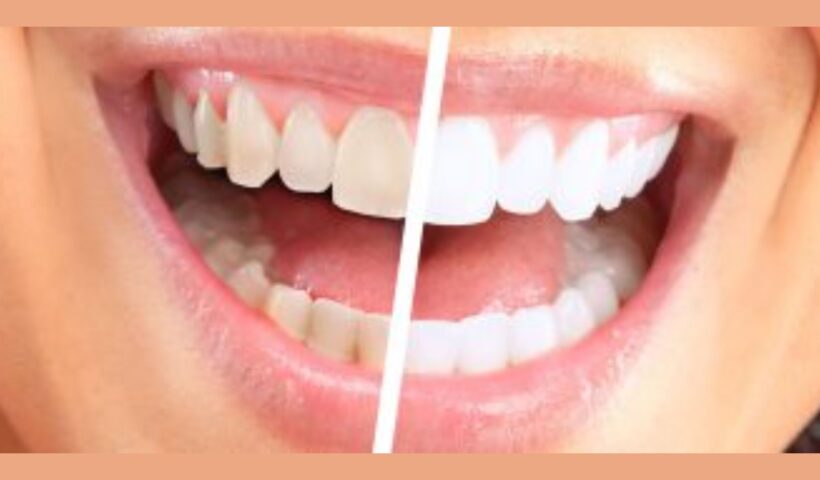The Smile Makeover Why You Should Consider Teeth Whitening