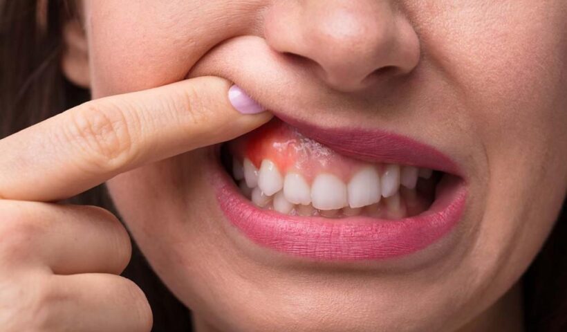 cephalexin for tooth infections