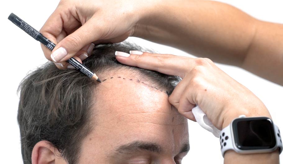 Revitalizing Confidence: A Comprehensive Exploration of Hair Transplantation