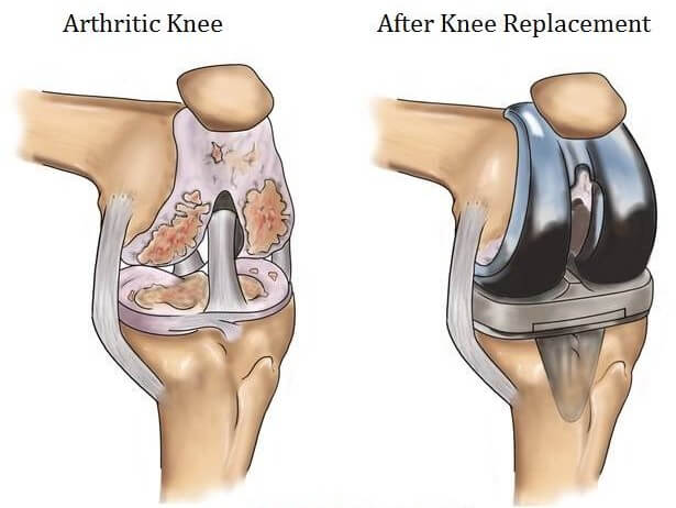 knee replacement