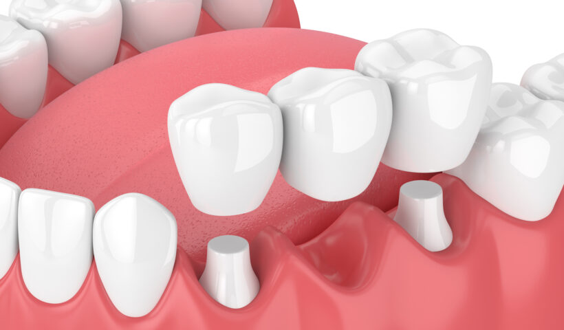 Dental bridges in rochdale