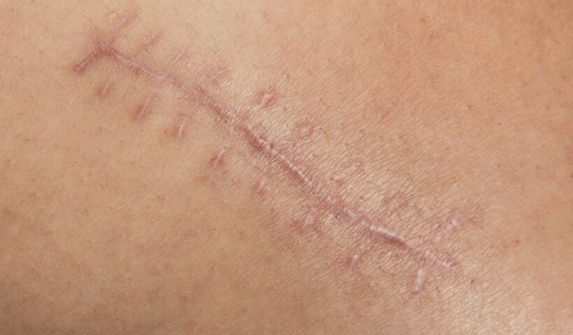 Scar Tissue Formation and its Impact on Postoperative Recovery