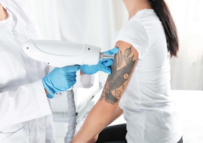 Tattoo Removal Costs & Services