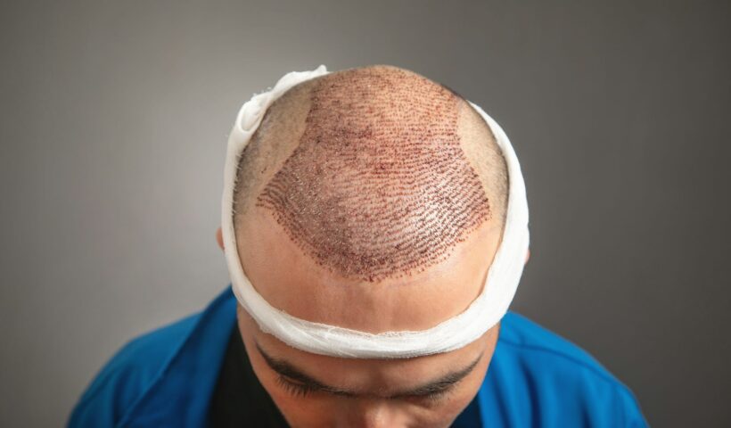 Hair transplant in Islamabad