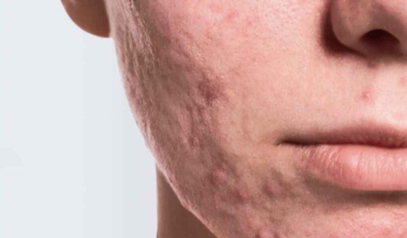 Acne Scar Removal