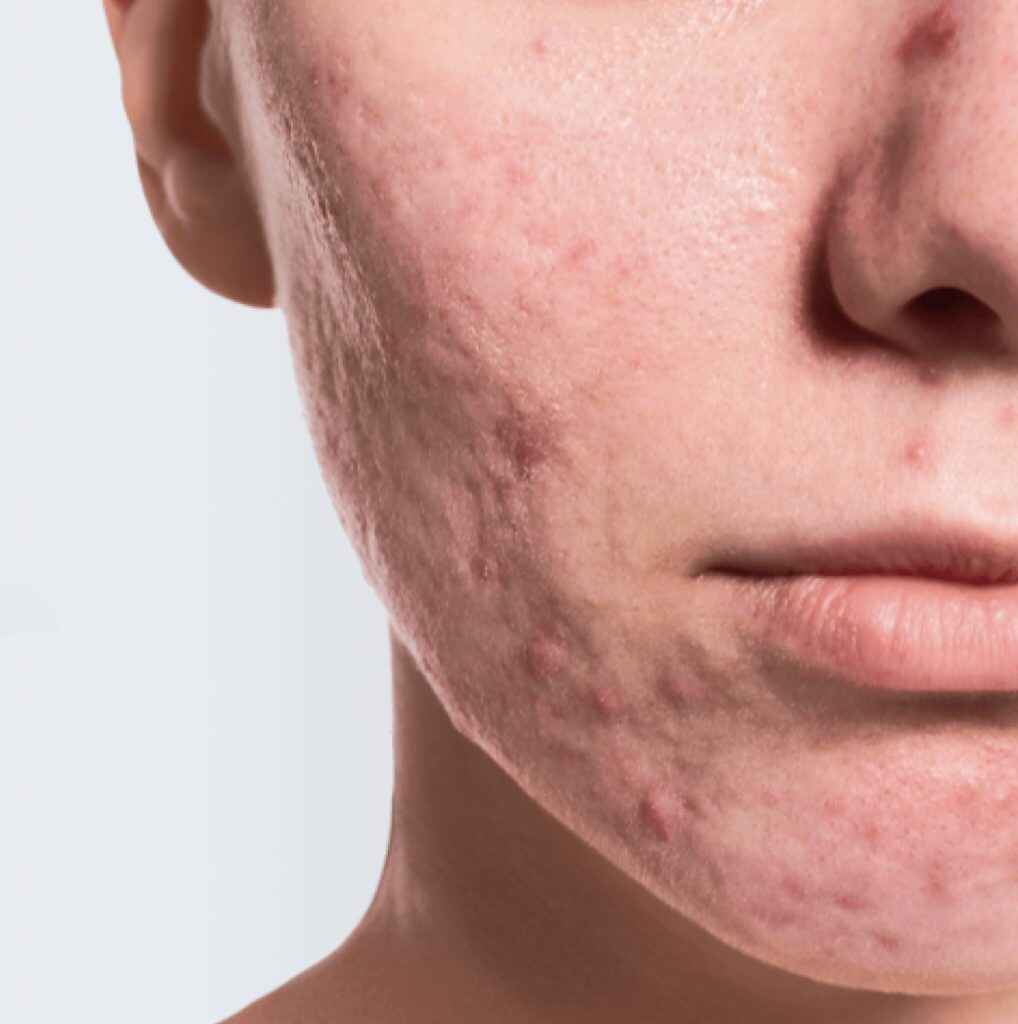 Acne Scar Removal